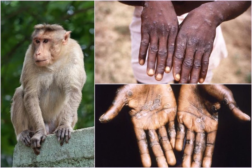 WHO ban bố tình trạng khẩn cấp y tế toàn cầu về bệnh đậu mùa khỉ (Nguồn: Collage)
