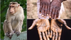Bệnh đậu mùa khỉ không còn là tình trạng khẩn cấp y tế toàn cầu