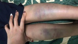 Đà Nẵng: Không bao che vụ học sinh lớp 1 bị đánh bầm tím chân tại trường