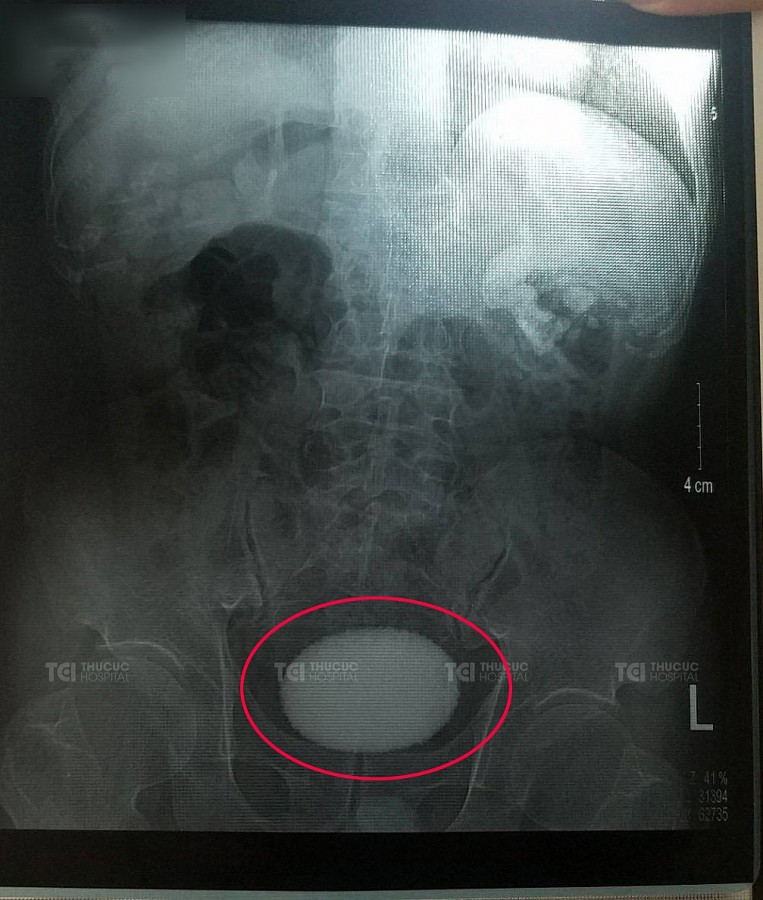 : Viên sỏi bàng quang có hình dáng và kích thước tương tự như quả trứng vịt trên phim chụp X-Quang của bệnh nhân T