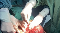 Phẫu thuật cắt bỏ khối u buồng trứng "khủng" nặng 2,6kg