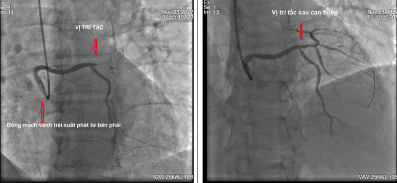 Hình ảnh chụp động mạch vành trước và sau khi can thiệp.