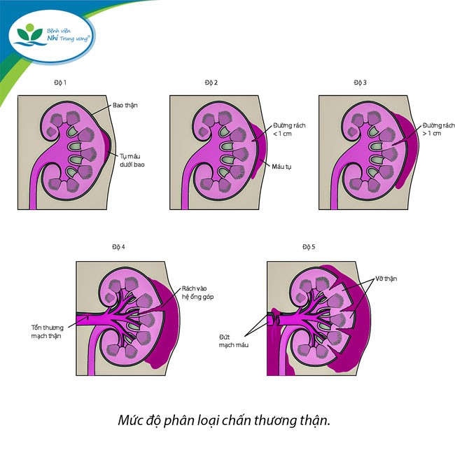 Bé gái bị chấn thương thận nặng do tai nạn trượt chân ngã