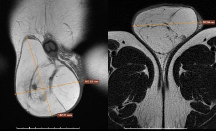Hình ảnh chụp khối u tại vùng bìu bệnh nhân - Ảnh: BVCC © Được Tuổi trẻ cung cấp