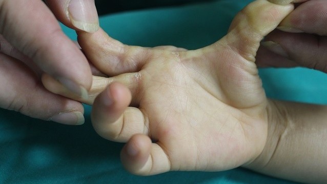Sử dụng các phương pháp phẫu thuật tạo hình trong điều trị sẹo co kéo ngón tay