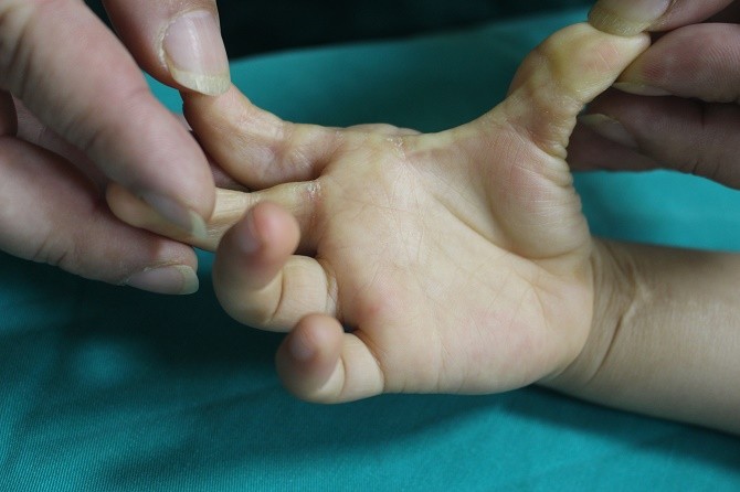 Sử dụng các phương pháp phẫu thuật tạo hình trong điều trị sẹo co kéo ngón tay tại BVĐK Đức Giang - Tin tức sự kiện - Cổng thông tin điện tử Sở y tế Hà Nội