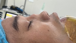 Biến dạng mũi do di chứng chấn thương
