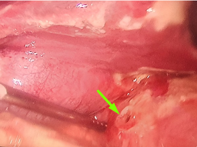 Ảnh thủng mặt trước hành tá tràng quan sát trong mổ của bệnh nhân Đ (mũi tên xanh)