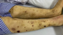 Chữa đau chân tay bằng ong đốt, bệnh nhân nhập viện cấp cứu