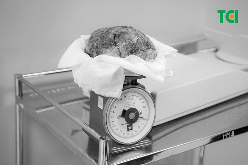 Khối u xơ tử cung “khủng” nặng đến 1.5kg (Ảnh TCI)