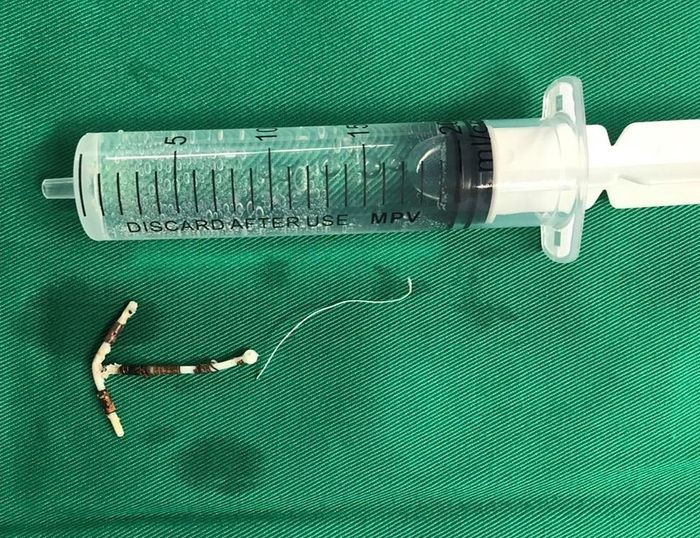 Dị vật vòng tránh thai hình T được gắp ra ngoài. Dị vật vòng tránh thai hình T được gắp ra ngoài.