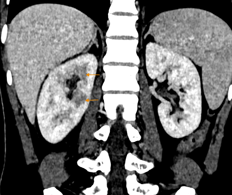 Hình ảnh CT của bệnh nhân cho thấy nhu mô thận ngấm thuốc không đều, biểu hiện của viêm thận