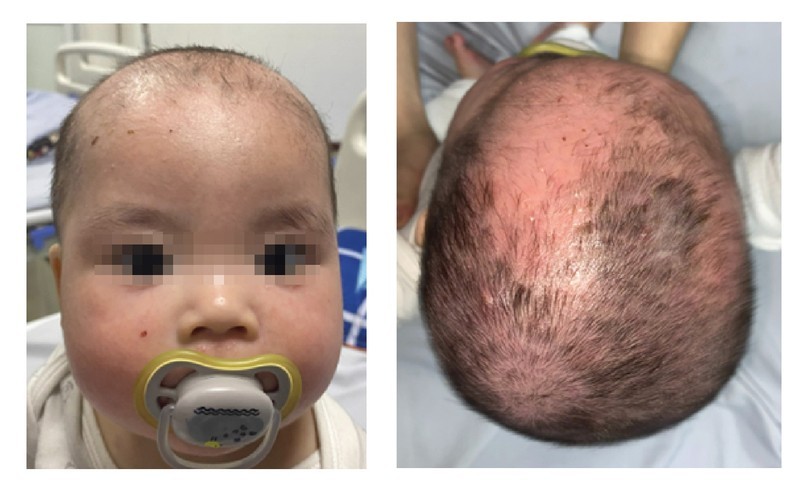 Hình ảnh của trẻ sau 4 ngày điều trị Bệnh viện Da liễu Trung ương. Ảnh: BVCC