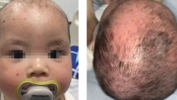 Tắm bằng các loại lá, bé trai 8 tháng tuổi bị bong tróc toàn bộ da đầu