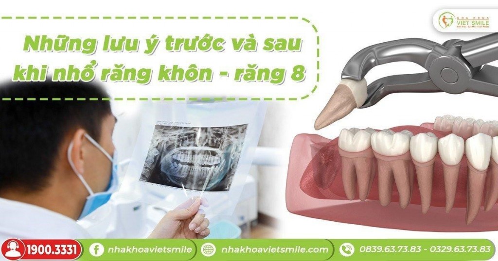 Lưu ý cần nhớ trước và sau khi nhổ răng khôn