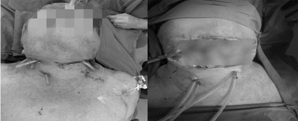 Bệnh nhân Th trước và sau khi phẫu thuật
