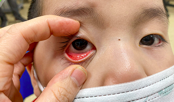Đau mắt đỏ ở trẻ em có thể gây nhiều biến chứng
