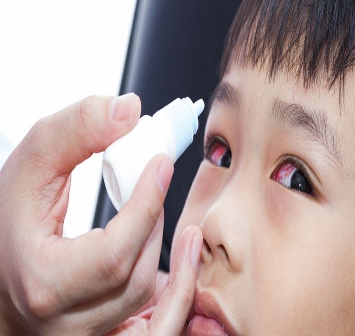 Đau mắt đỏ ở trẻ gia tăng cha mẹ cần phải biết 5 điều sau để nhanh khỏi và phòng bệnh