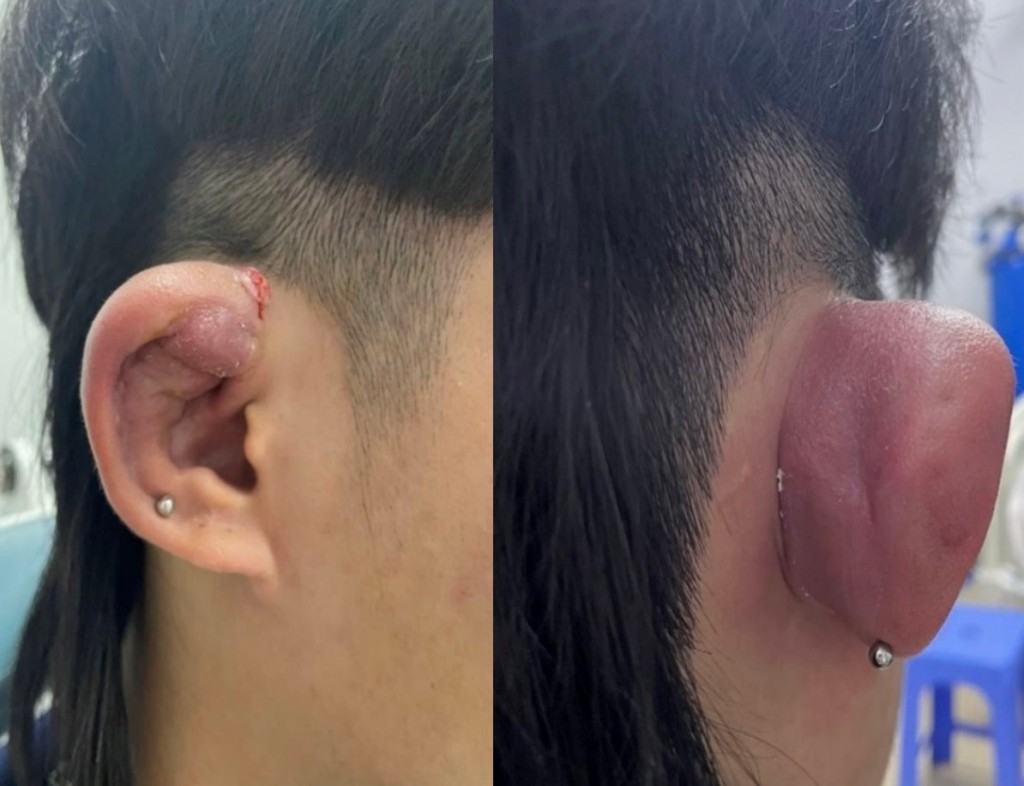 Tình trạng tai của bệnh nhân bị biến dạng do sở thích xâu nhiều khuyên tai