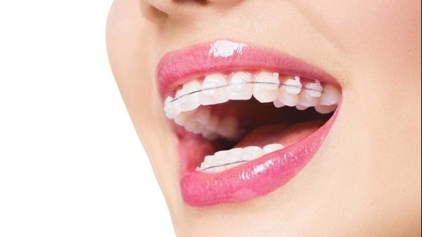 Niềng răng - Lựa chọn hoàn hảo để sở hữu hàm răng đều đẹp