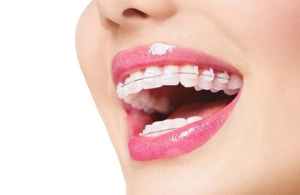 Niềng răng là giải pháp nên lựa chọn để có được hàm răng đều đẹp