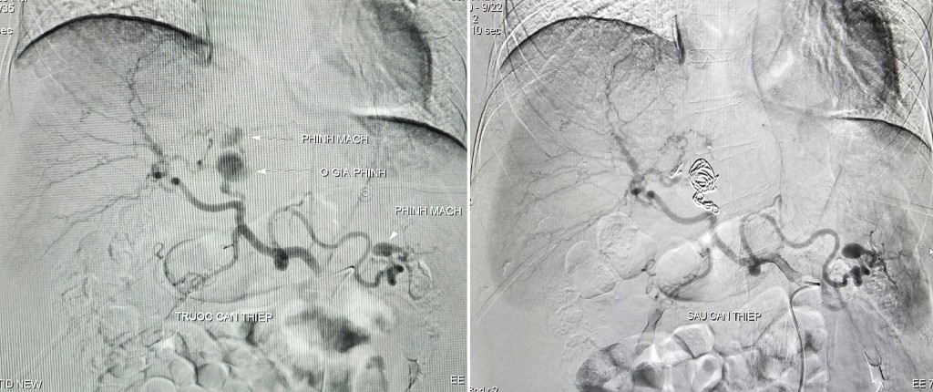 Can thiệp nội mạch thành công ca vỡ phình động mạch gan hiếm gặp