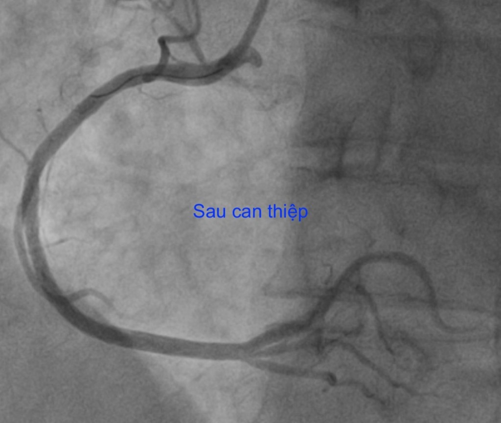 Hình ảnh trước và sau can thiệp bệnh nhân bị nhồi máu cơ tim.