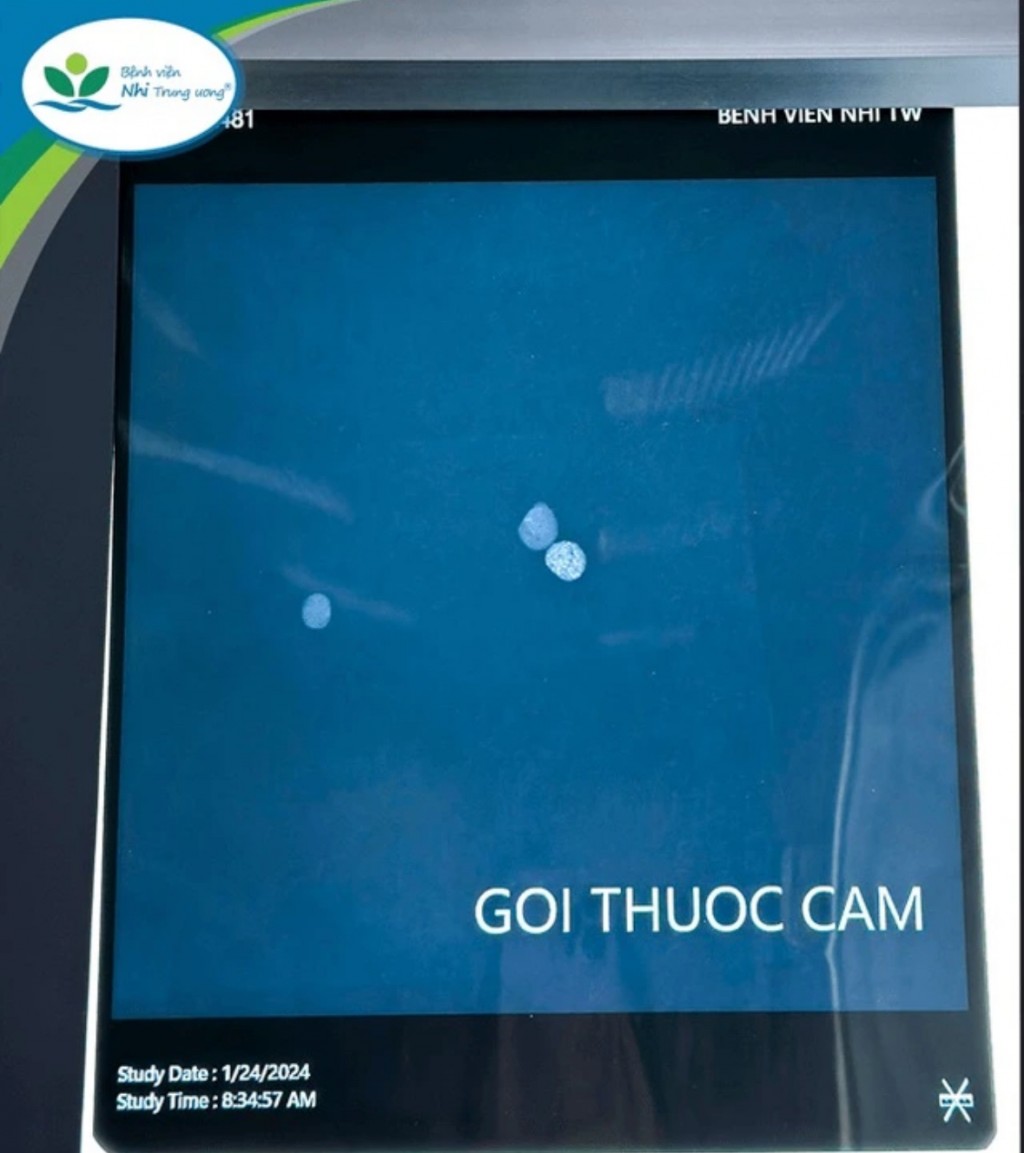 Hình ảnh phim chụp X-Quang cản quang của thuốc cam do gia đình cho trẻ uống. Ảnh BVCC