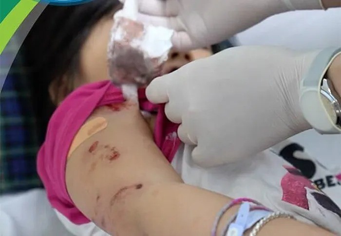 Bé gái 5 tuổi (Hà Giang) bị chó cắn điều trị tại hoa Cấp cứu và Chống độc, Bệnh viện Nhi Trung ương