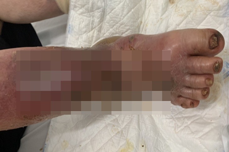 bàn chân của một nữ bệnh nhân 58 tuổi (ngụ Thái Nguyên) bị sưng vù, da rất mỏng, gây rách da, nhiễm trùng nặng... - Ảnh: Bệnh viện cung cấp