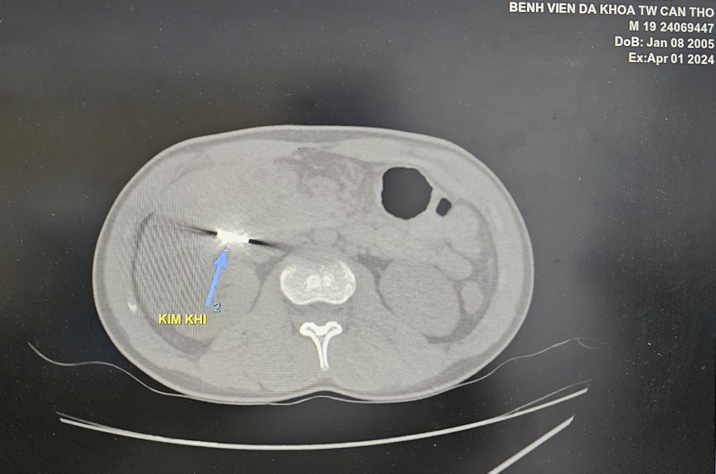 Hình  kim khí trên phim chụp cắt lớp vi tính bụng có cản quang