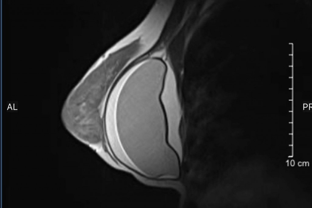 Hình ảnh MRI ngực trái của bệnh nhân (Ảnh: BSCC).