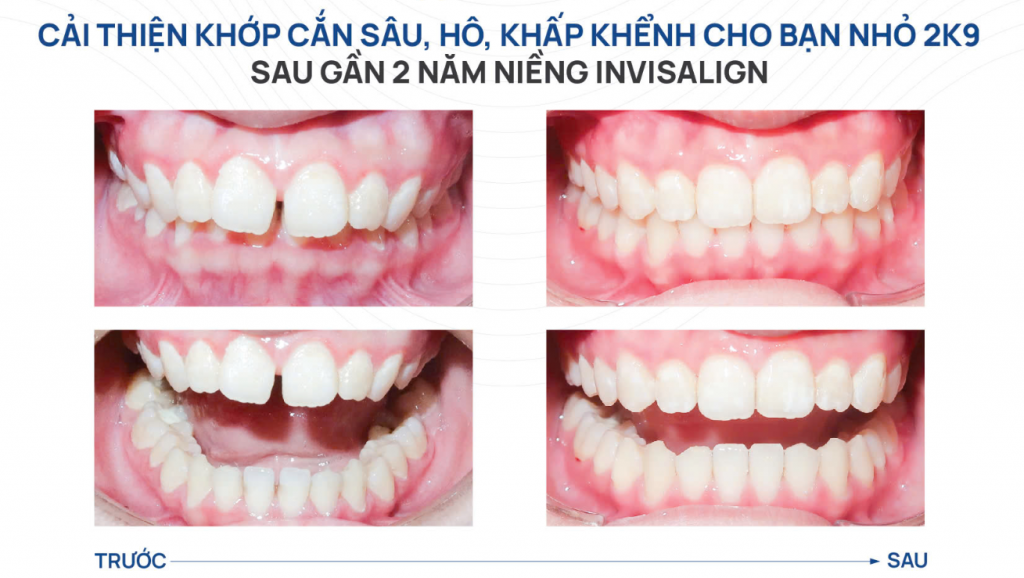 Cải thiện khớp cắn sâu, hô, khấp khểnh sau gần 2 năm niềng răng Invisalign