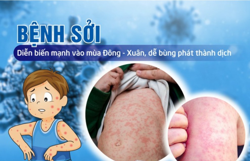 Tây Ninh chỉ đạo kiểm soát, ngăn ngừa bệnh sởi lây lan