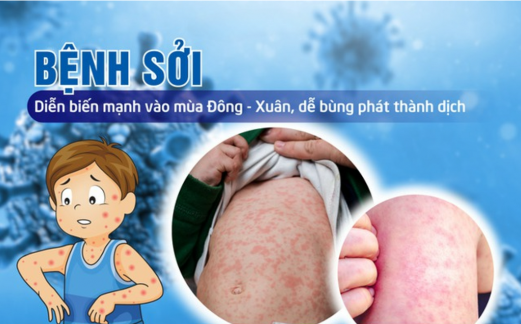 Tây Ninh chỉ đạo kiểm soát, ngăn ngừa bệnh sởi lây lan