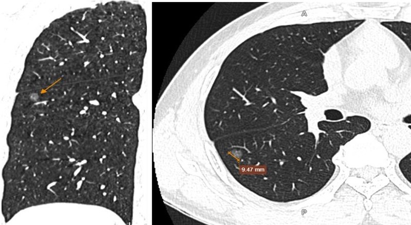Hình ảnh nốt kính mờ phân thùy S6 phổi phải đường kính 9,5mm, kèm một số nốt rải rác nhu mô hai phổi
