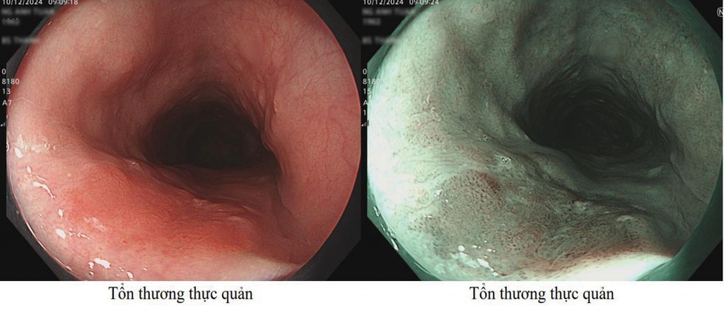 Mắc ung thư thực quản vì hút thuốc lá “không ngừng” suốt 20 năm