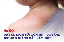 Hà Nội: Dự báo dịch sởi tiếp tục tăng trong 3 tháng đầu năm