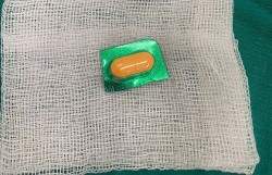 Gắp thành công vỏ thuốc sắc nhọn ở thực quản bệnh nhân