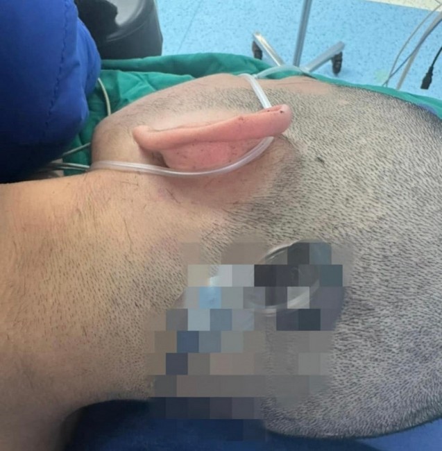 Cấp cứu nam học sinh bị chìa khóa cắm sâu vào đầu