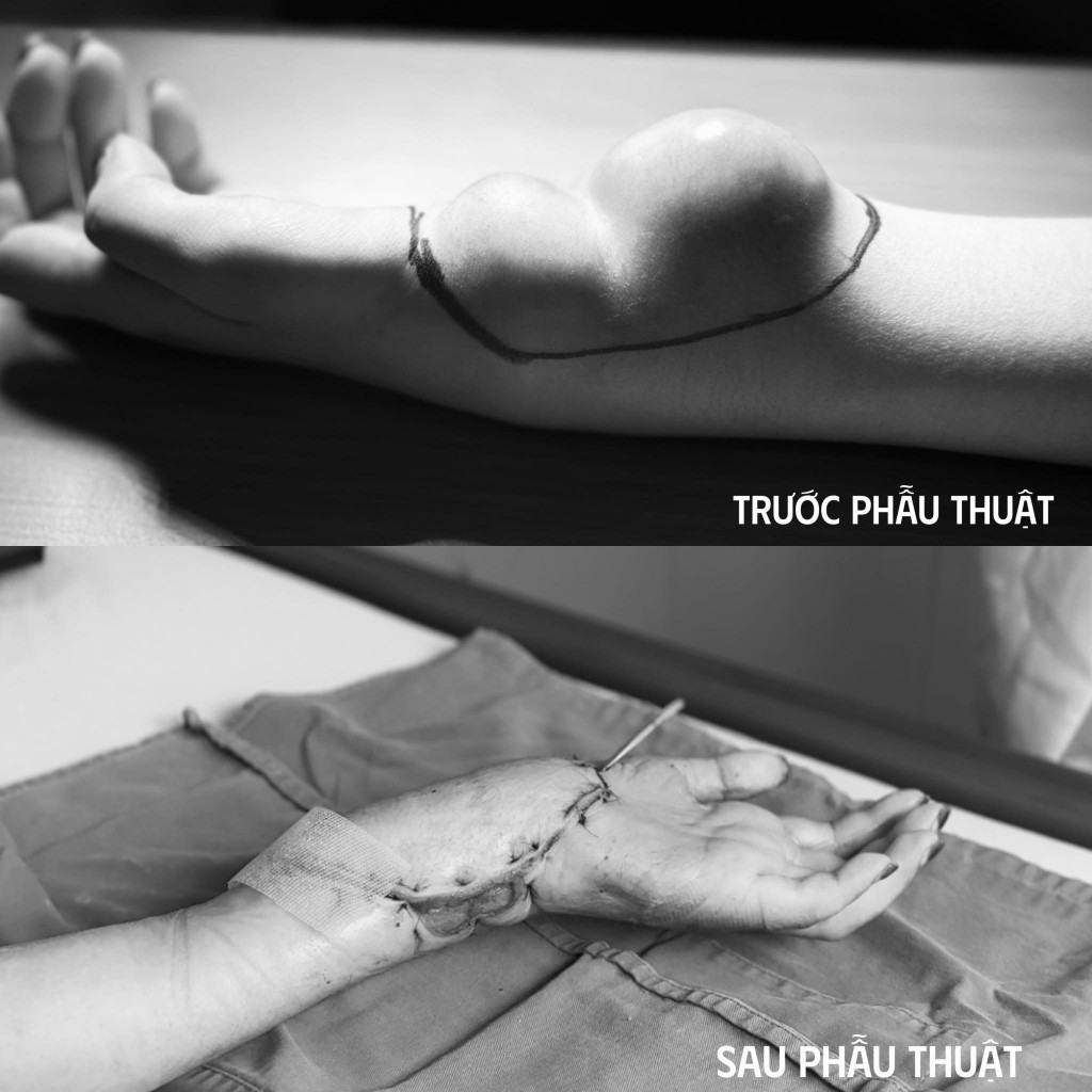 Khối u ở tay bệnh nhân trước và sau khi phẫu thuật. Ảnh BVCC