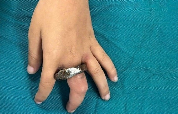 Cấp cứu cho em bé bị kẹt ngón tay trong ổ khóa