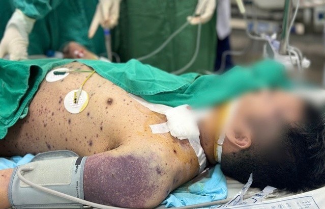 Không nên coi thường biến chứng thủy đậu