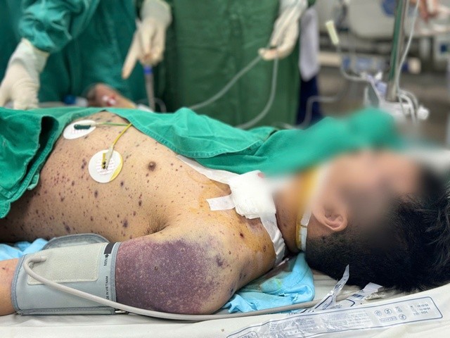 Tổn thương ở bệnh nhân mắc thủy đậu. 