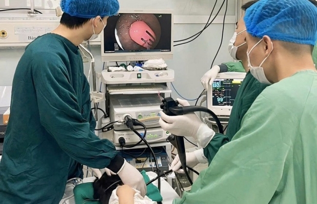 Gắp dị vật là kẹp tóc dài trong dạ dày bé 21 tháng tuổi