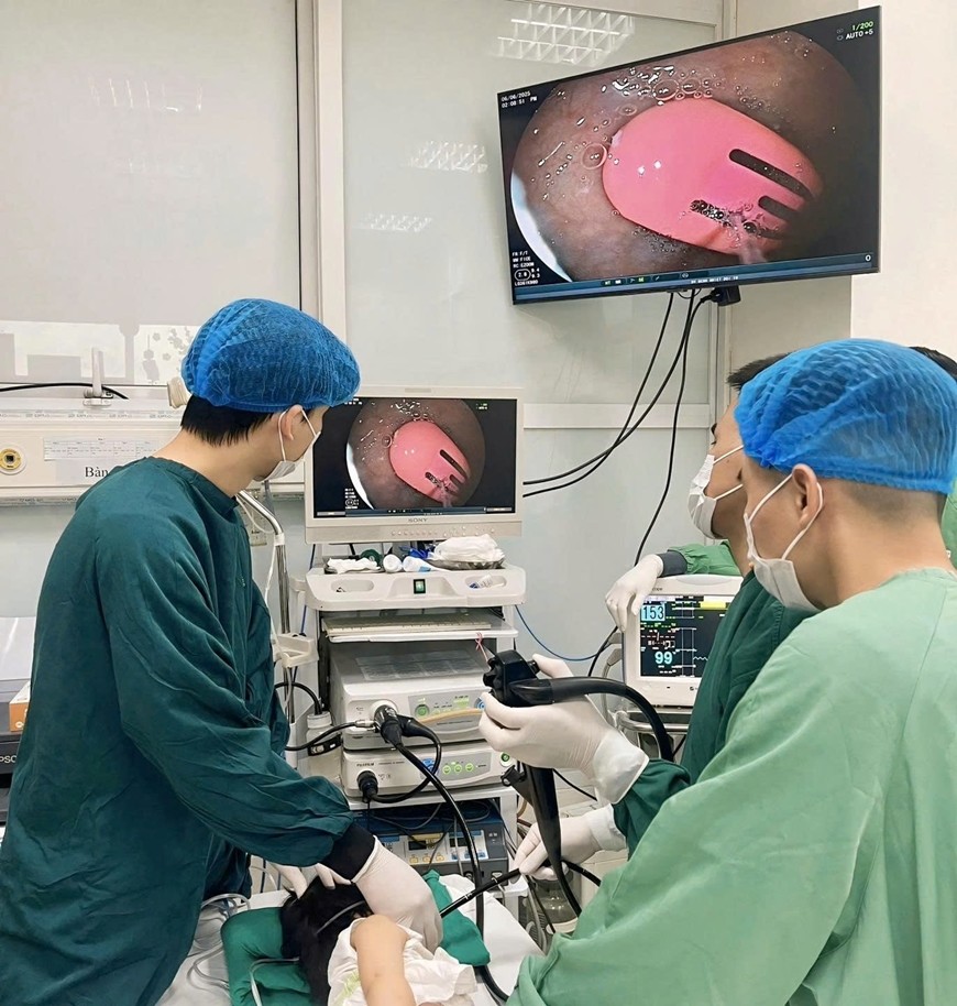 Các bác sĩ lấy chiếc kẹp tóc ra khỏi dạ dày bệnh nhi. Ảnh: Bệnh viện cung cấp