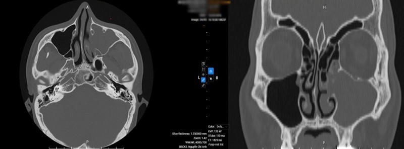 Hình ảnh chụp cắt lớp vi tính mũi xoang ghi nhận polyp xoang hàm trái, niêm mạc xoang sàng hai bên dày