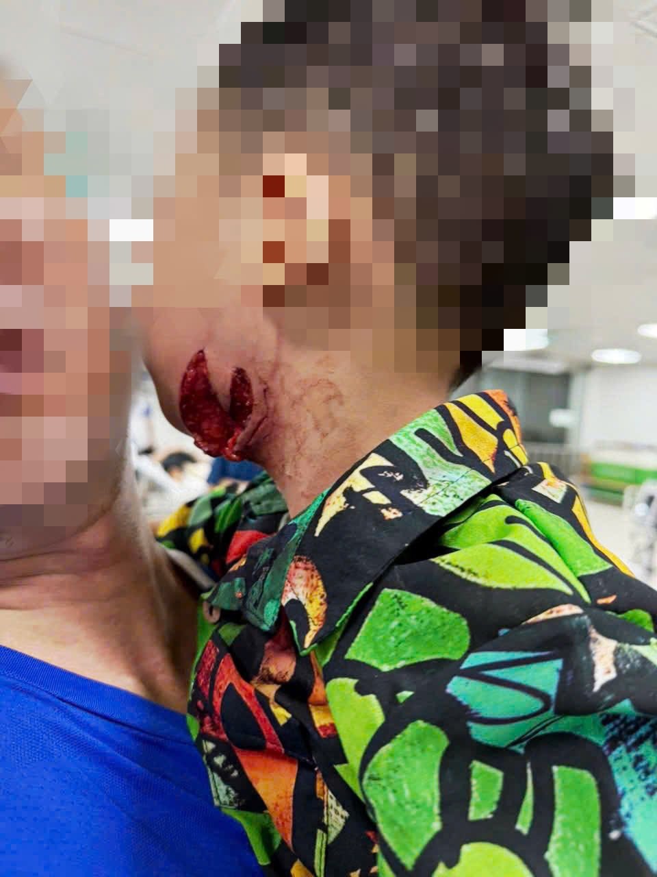 Trẻ bị chó cắn được điều trị tại BV Bệnh Nhiệt đới T.Ư. Ảnh: BVCC