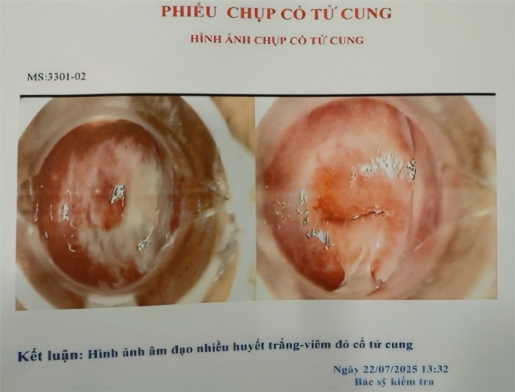 Hình ảnh chụp cổ tử cung bệnh lý, có mã số (ký hiệu MS) có sẵn trong máy tính của bác sĩ V.T.T tại Phòng khám đa khoa Quốc tế Khang Thịnh (ảnh: SYT)