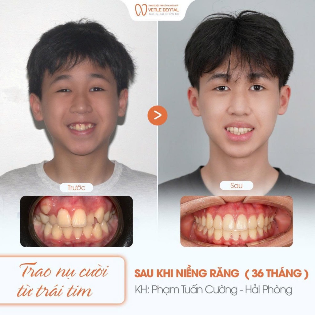 Chỉnh nha, niềng răng, cần quan tâm càng sớm càng tốt.